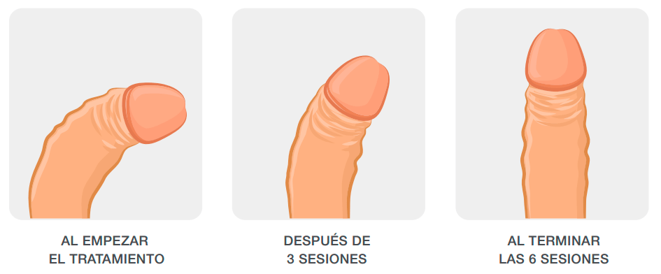 dioxipp_sesiones dioxipp sesiones tratamiento